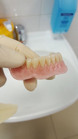 Съемный зубной протез Акри-Фри