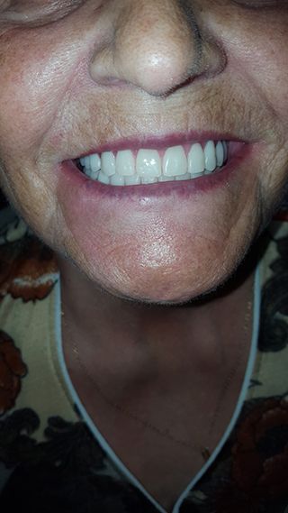Полный протез зубов Ivocap