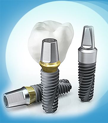 Имплантация зубов в СПб по доступной цене, импланты зубов