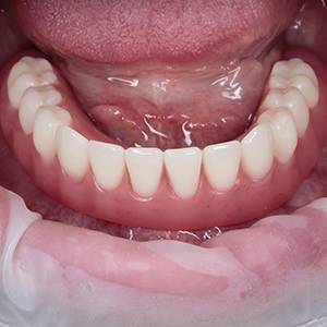 Балочный протез зубов