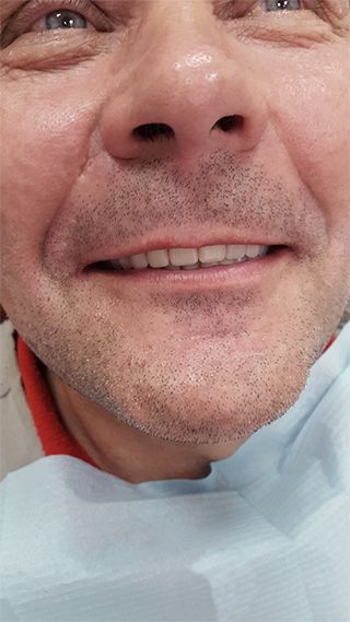 Полный протез зубов Acry-Free