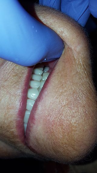 Полный протез зубов Ivocap