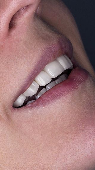 Реставрация зубов винирами E-Max