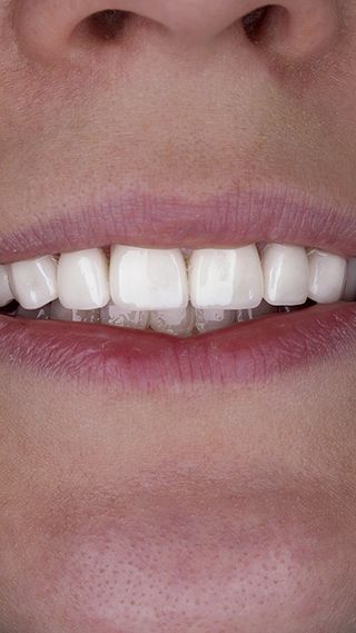 Реставрация зубов винирами E-Max