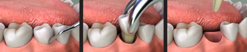 Стадии операции по удалению зуба