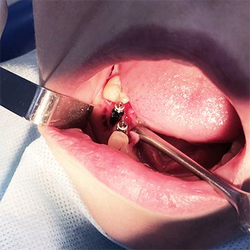 Цена установки имплантанта зуба в СПб