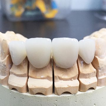 Хорошие зубы из металлокерамики