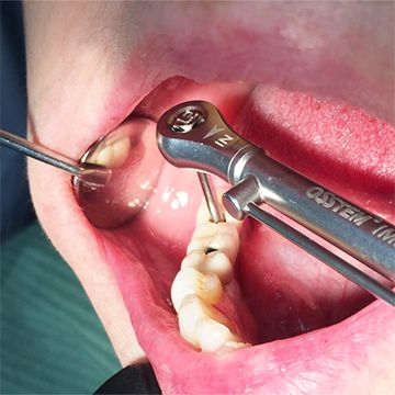 Имплантация зубов в СПб сравните цены