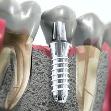 Имплантация зубов в СПб