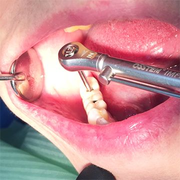 Имплантанты зубов в СПб