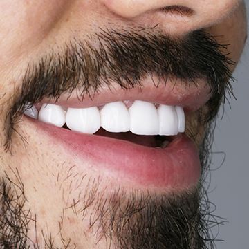 Лечение кариеса зубов в СПб