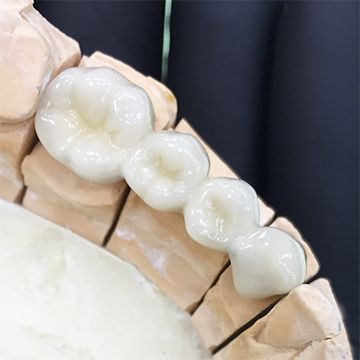 Протезы зубов из металлокерамики