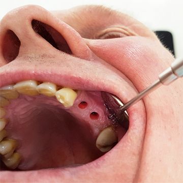 Сколько стоит имплантант зуба в СПб