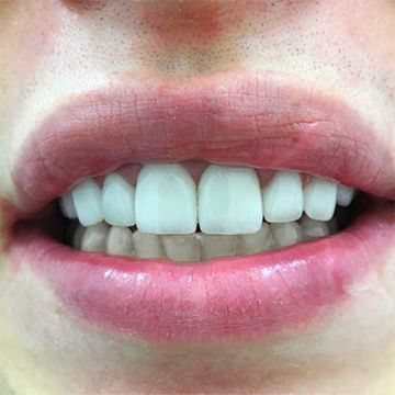 Виниры на два передних зуба при диастеме