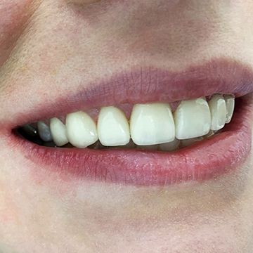 Восстановление зубов винирами в СПб