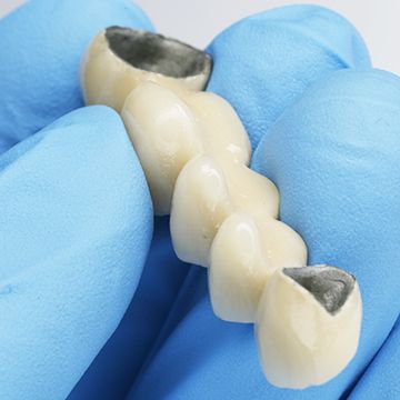 Зубные коронки из металлокерамики
